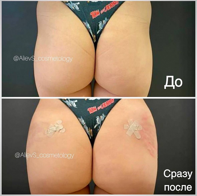 Увеличение ягодиц филлером